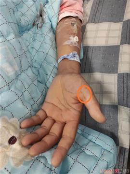 广西一女子因砍猪骨时拇指被刺出血患病