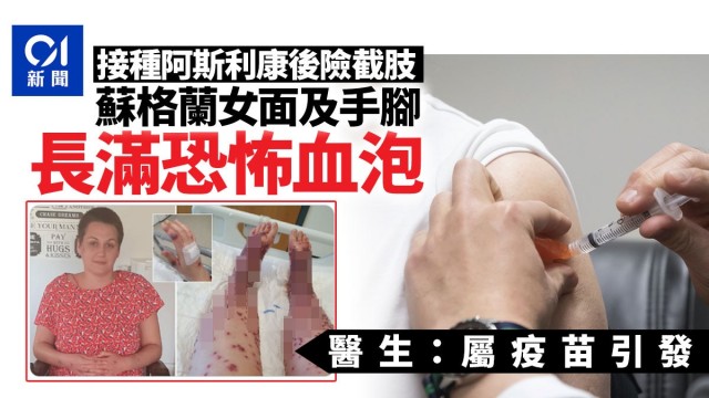 女子注射牛津疫苗面部及手脚长满血泡